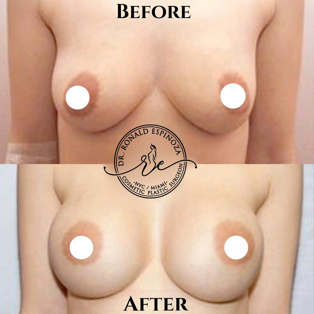 Breast Augmentation Before & After Gallery - Patient 99328915 - Image 1