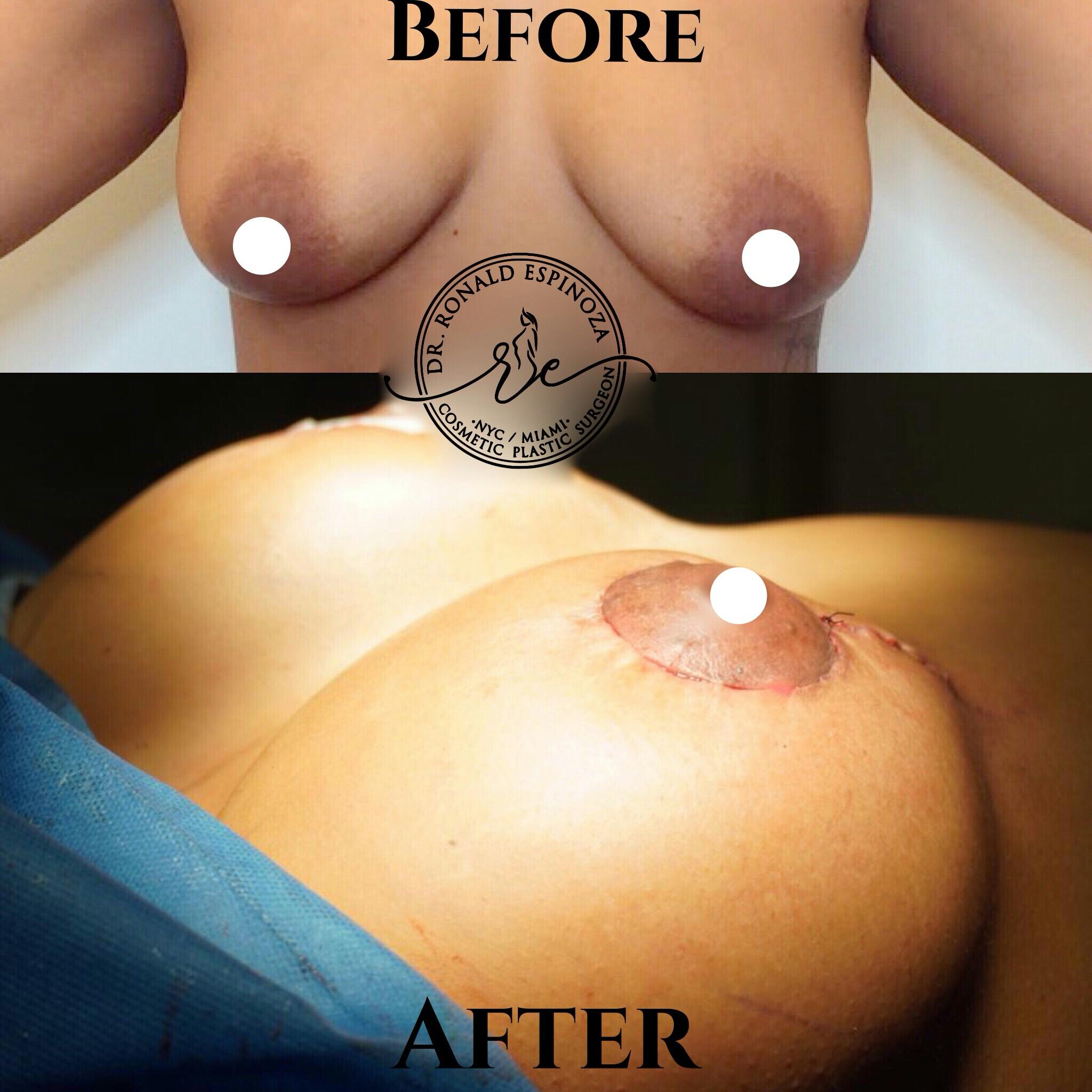 Breast Augmentation Before & After Gallery - Patient 99328916 - Image 1