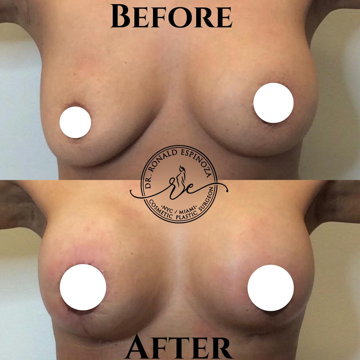 Breast Augmentation Before & After Gallery - Patient 99328917 - Image 1