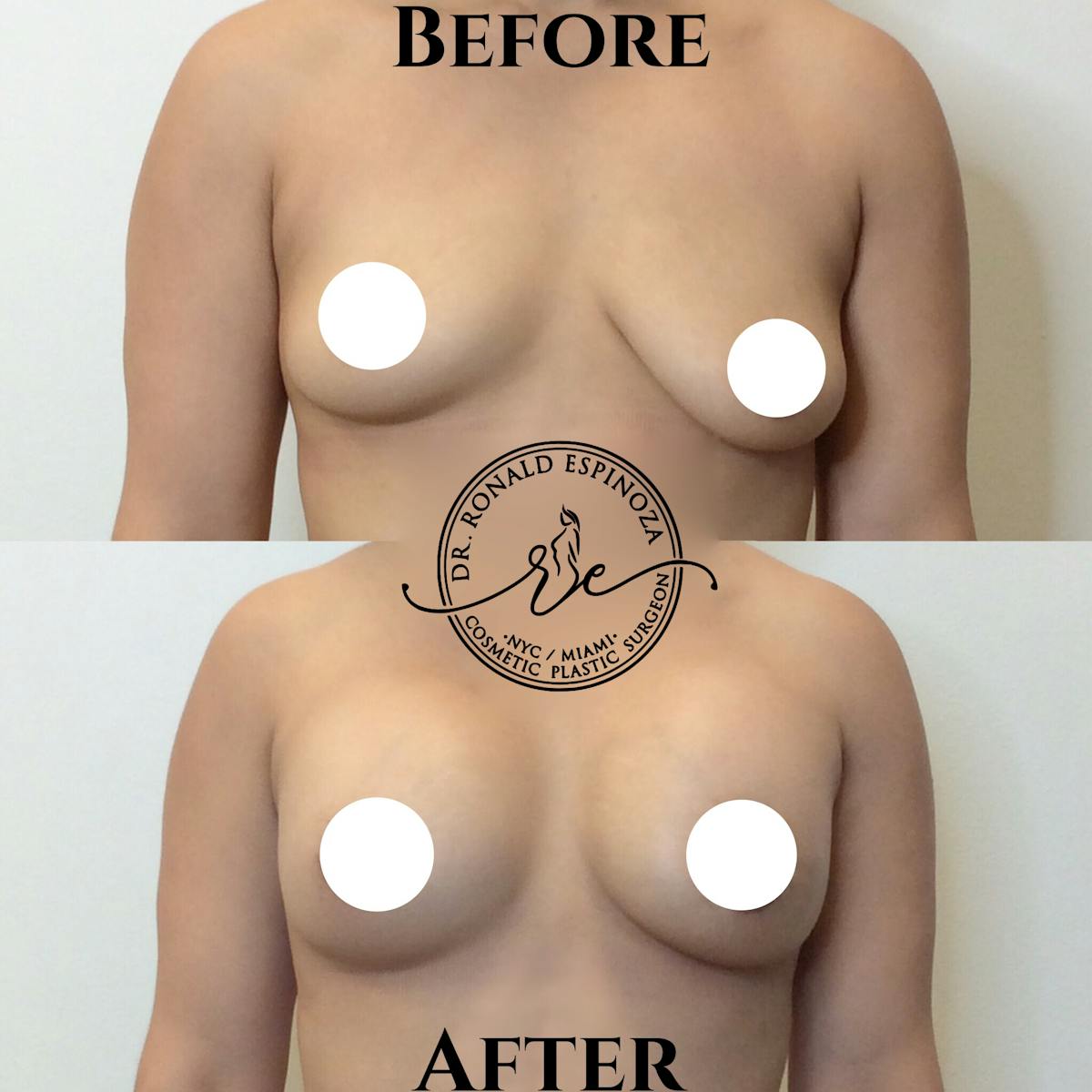 Breast Augmentation Before & After Gallery - Patient 99328918 - Image 1