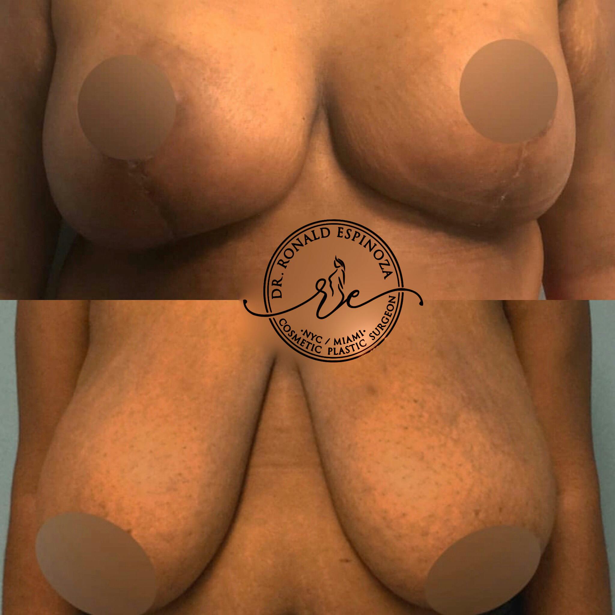 Breast Lift Before & After Gallery - Patient 99329040 - Image 1