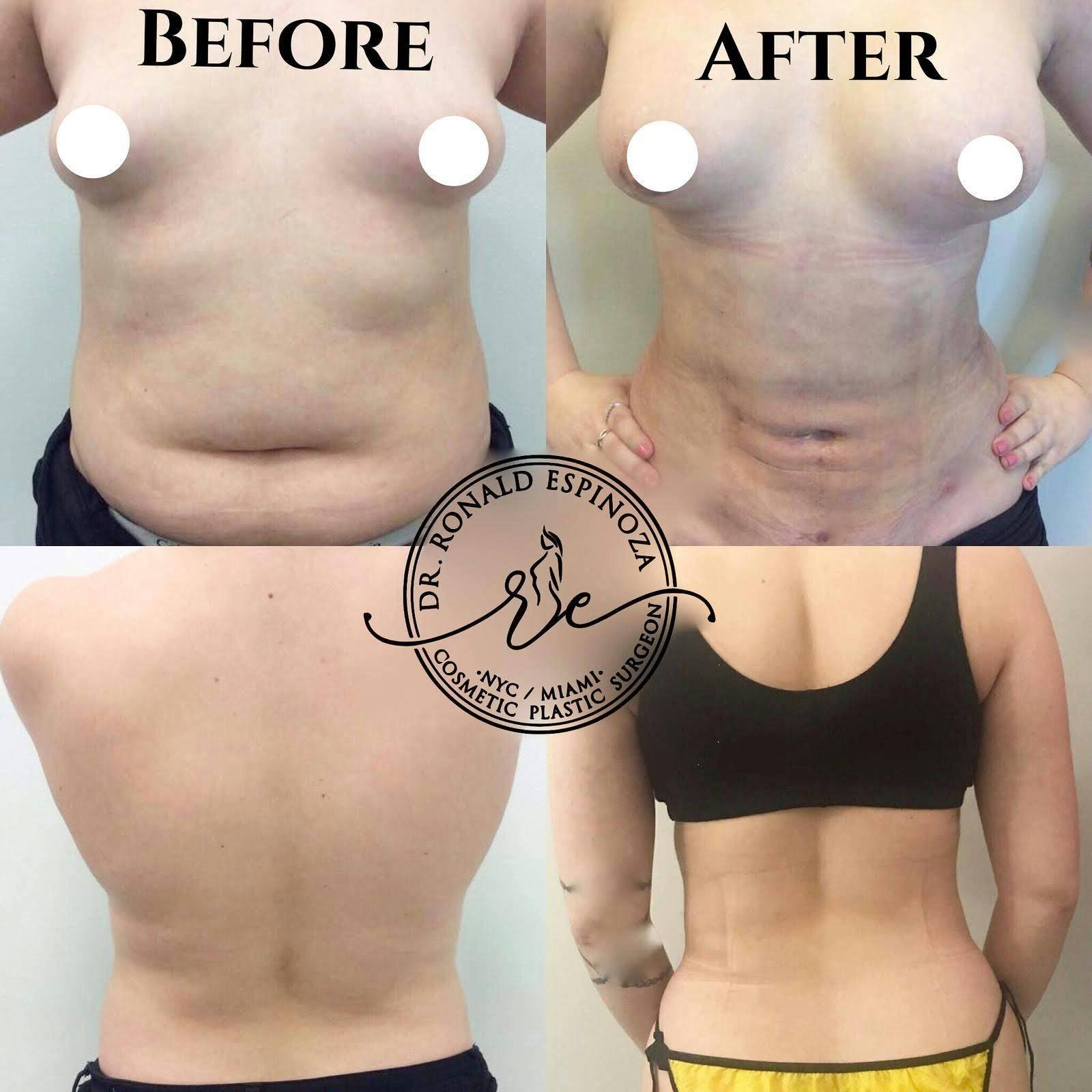 Liposuction Before & After Gallery - Patient 99329105 - Image 1