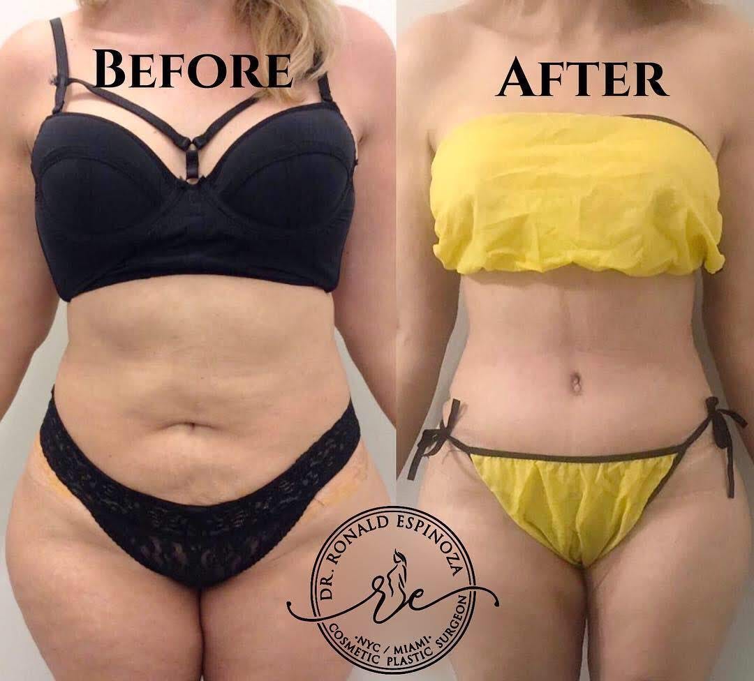 Liposuction Before & After Gallery - Patient 99329106 - Image 1