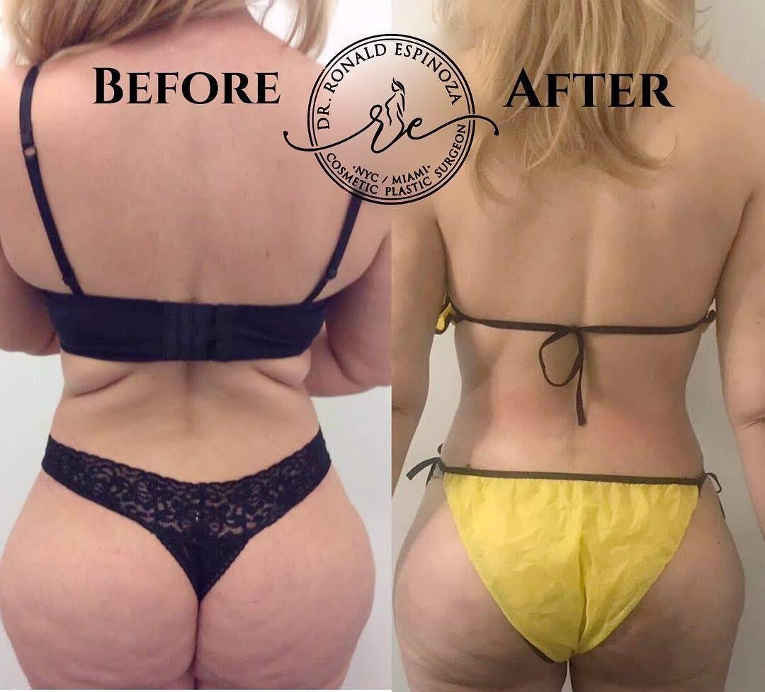 Liposuction Before & After Gallery - Patient 99329106 - Image 2