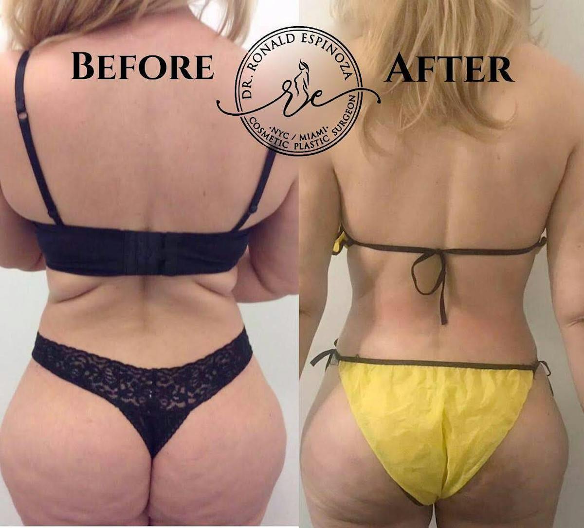 Tummy Tuck Before & After Gallery - Patient 99329126 - Image 2