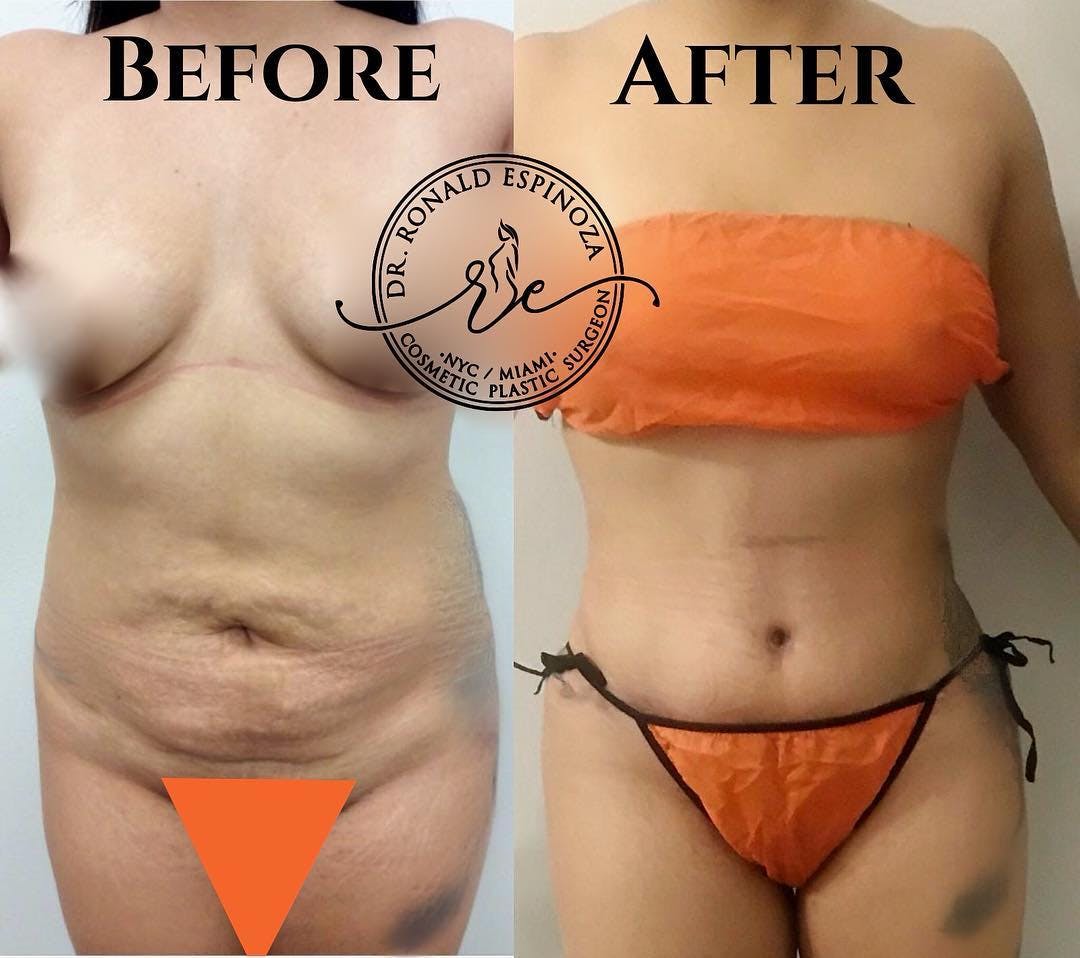 Brazilian Butt Lift Before & After Gallery - Patient 99329202 - Image 2
