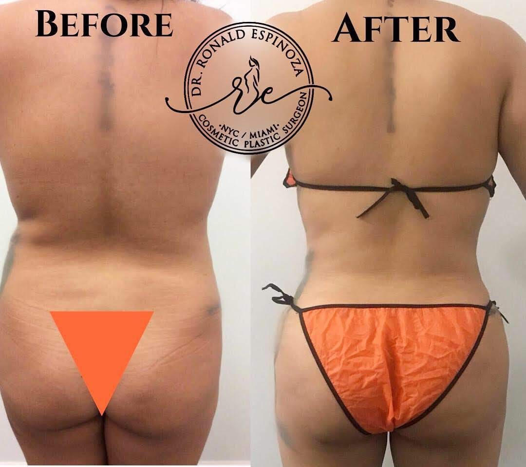 Brazilian Butt Lift Before & After Gallery - Patient 99329202 - Image 1