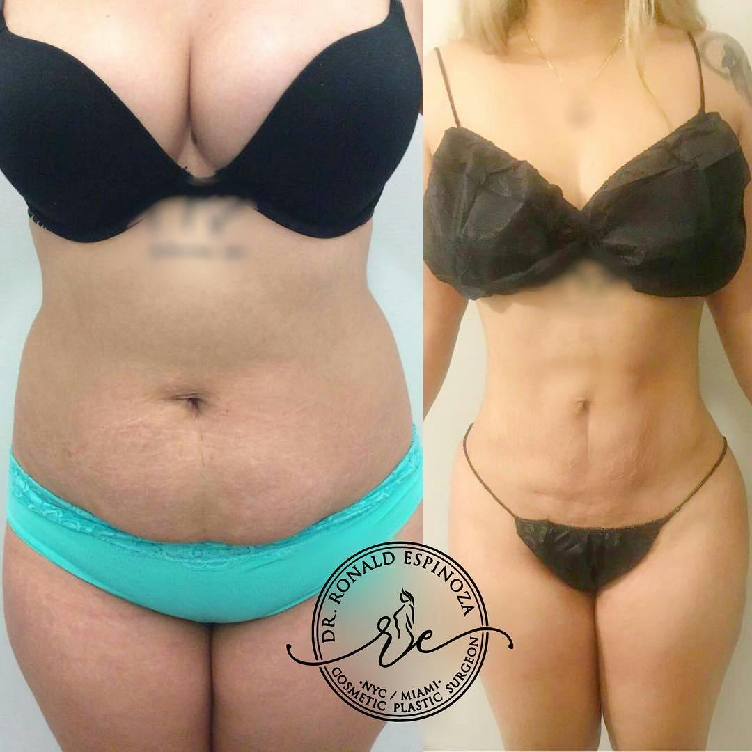 Liposuction Before & After Gallery - Patient 99329761 - Image 1