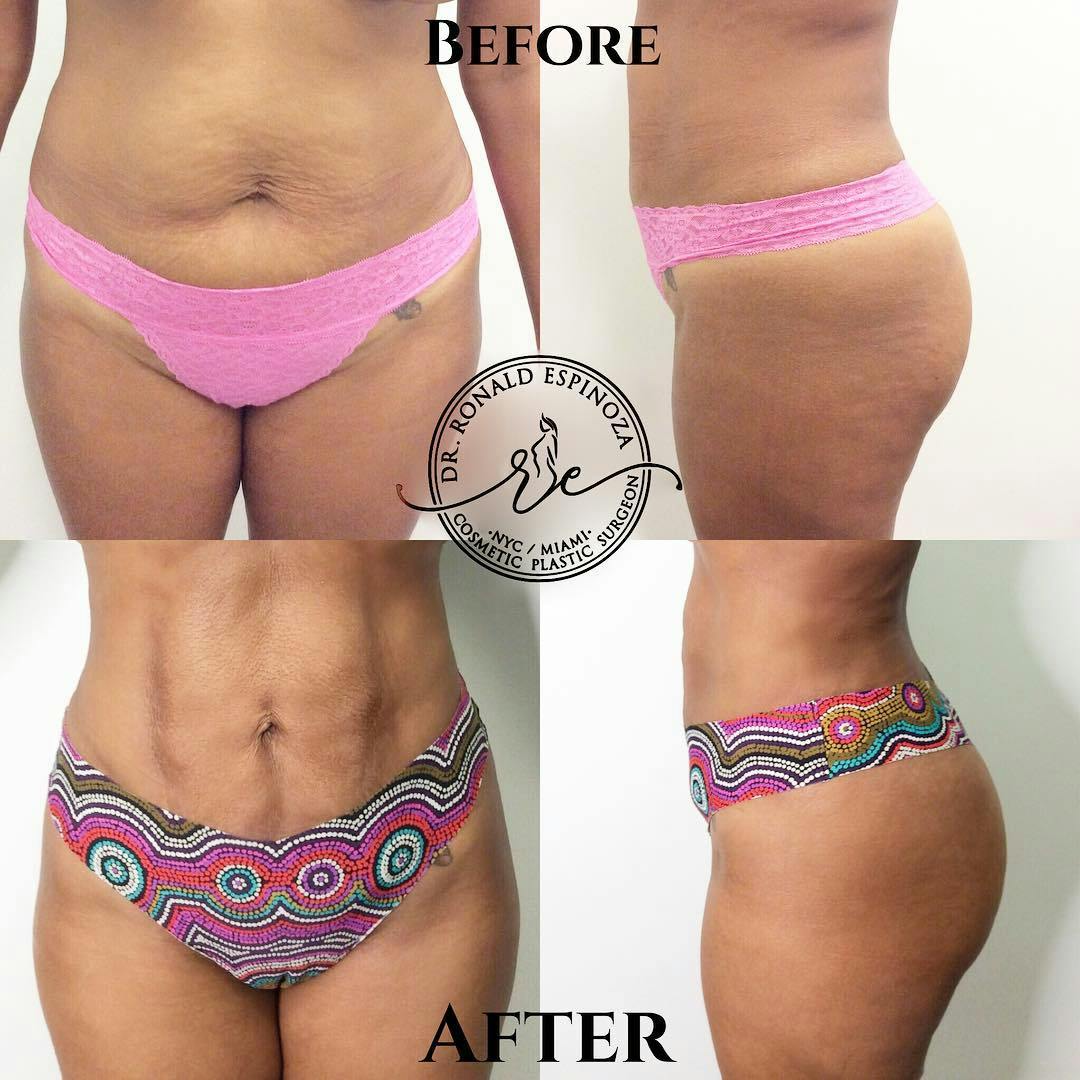 Liposuction Before & After Gallery - Patient 99329762 - Image 1