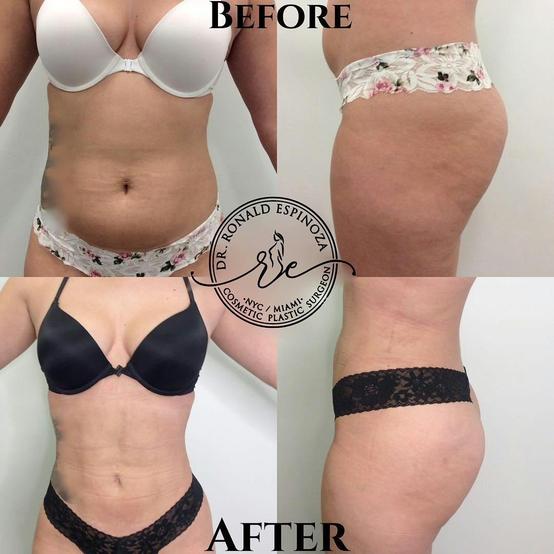Liposuction Before & After Gallery - Patient 99330184 - Image 1