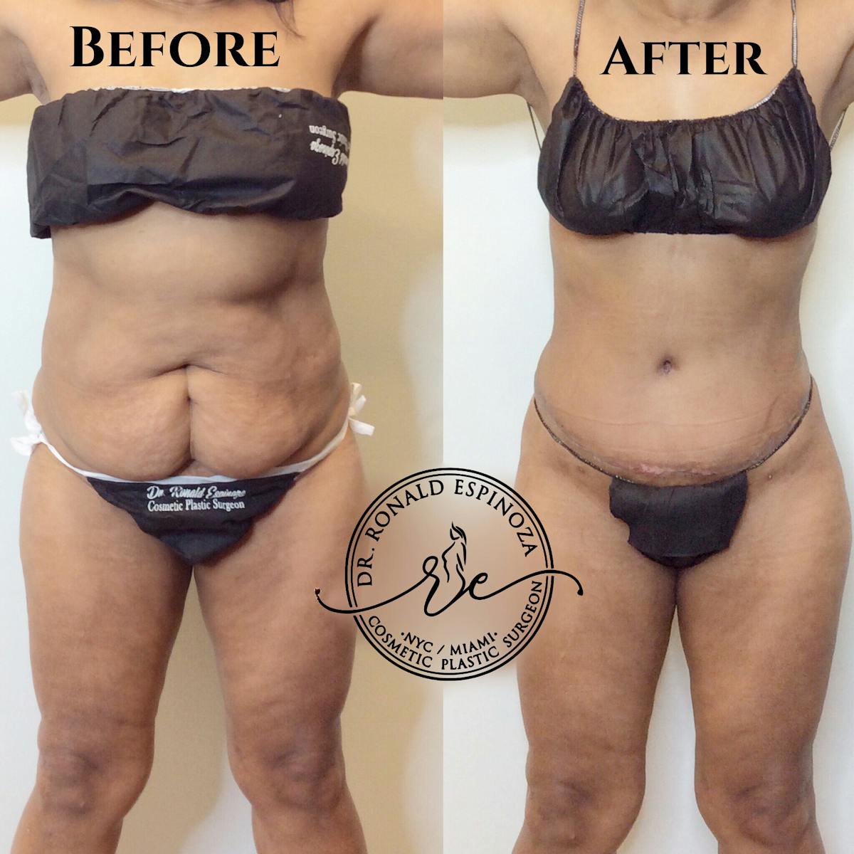 Tummy Tuck Before & After Gallery - Patient 99330194 - Image 1