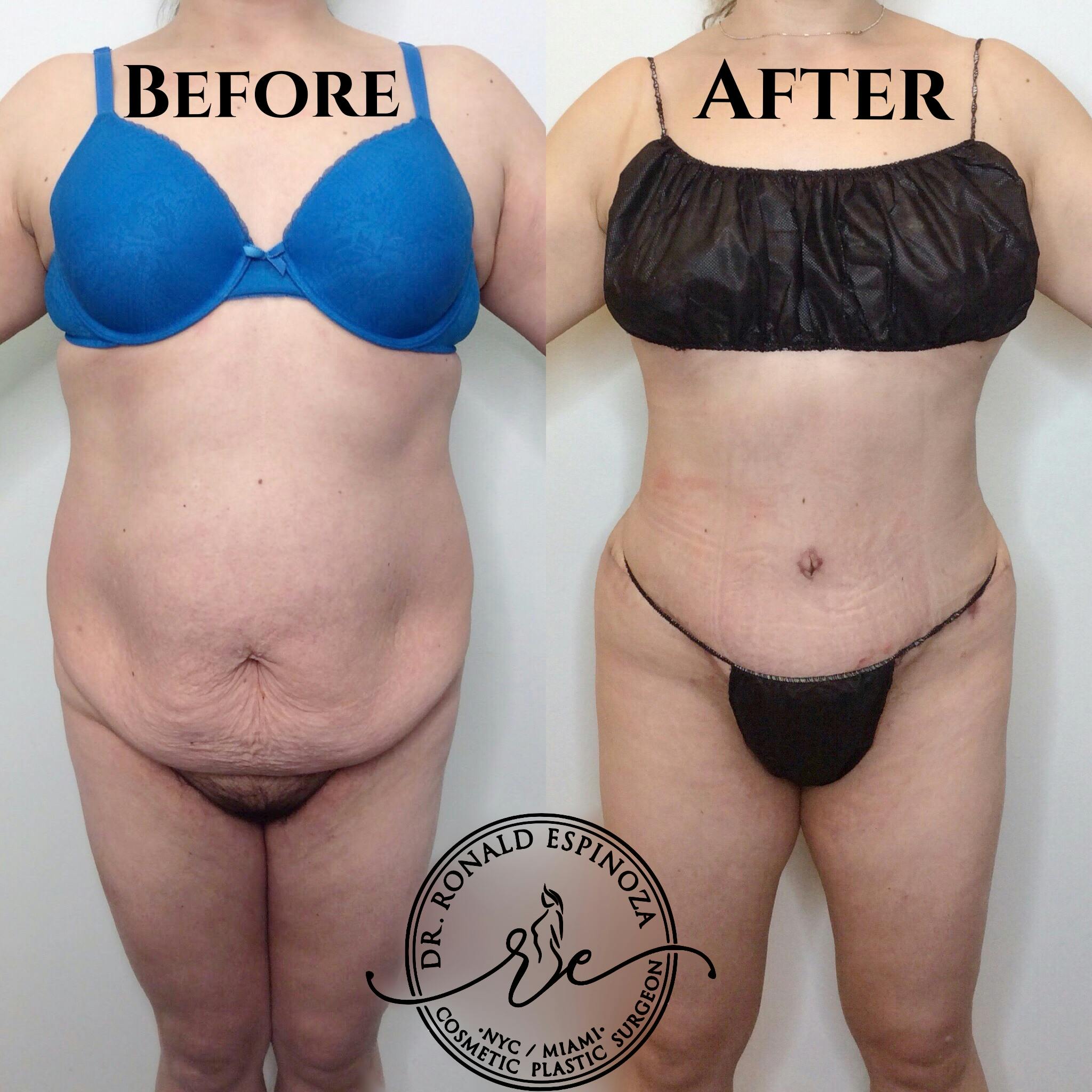 Tummy Tuck Before & After Gallery - Patient 99330232 - Image 1