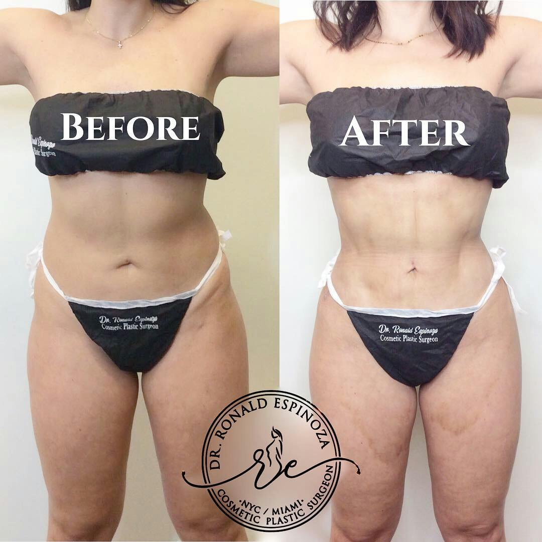Liposuction Before & After Gallery - Patient 99345351 - Image 1
