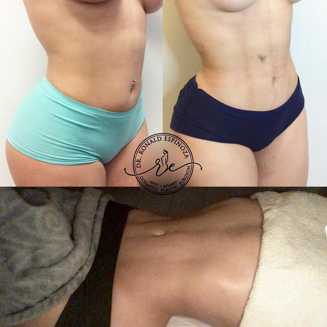 Liposuction Before & After Gallery - Patient 99345359 - Image 1