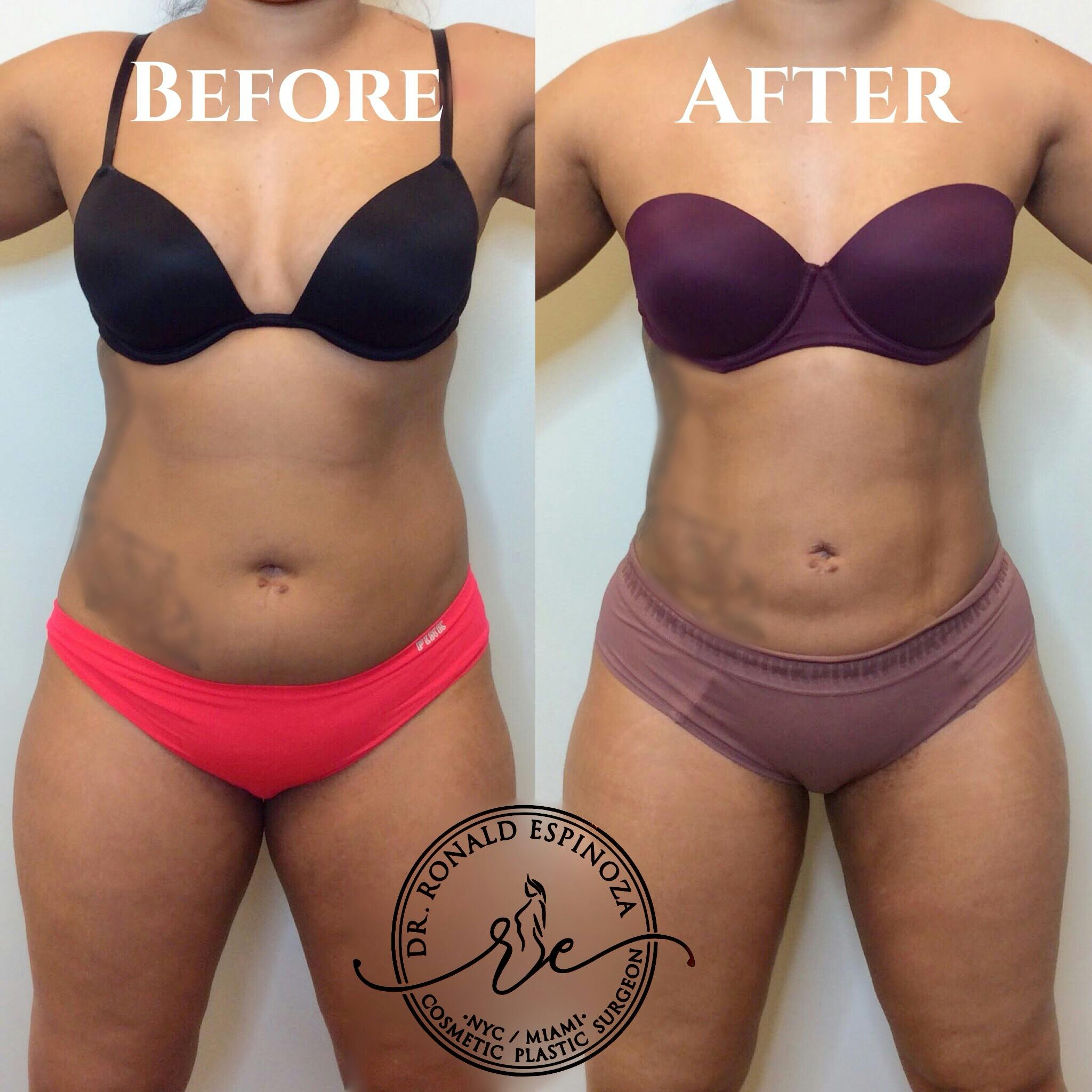 Liposuction Before & After Gallery - Patient 99345446 - Image 1