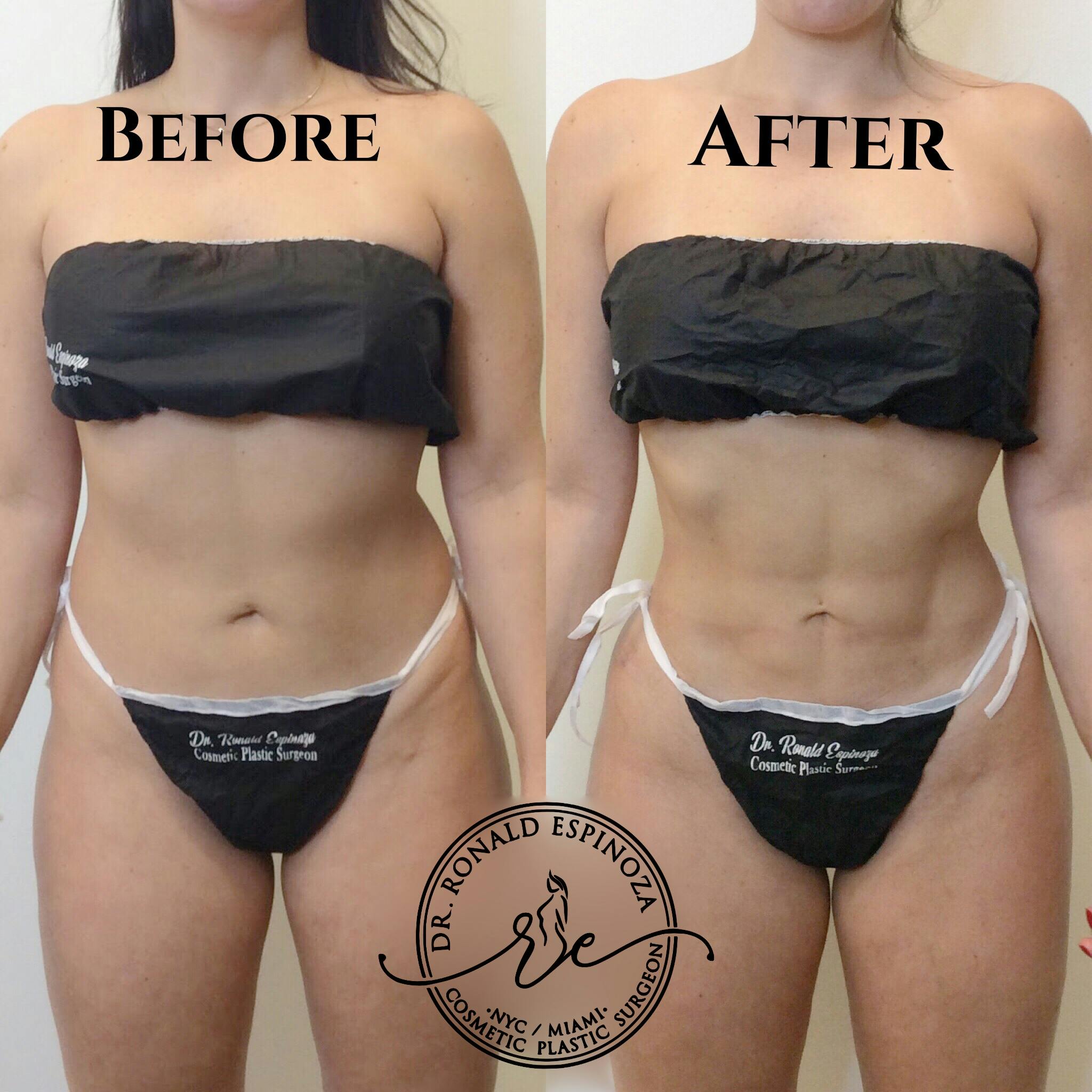 Liposuction Before & After Gallery - Patient 99345658 - Image 1