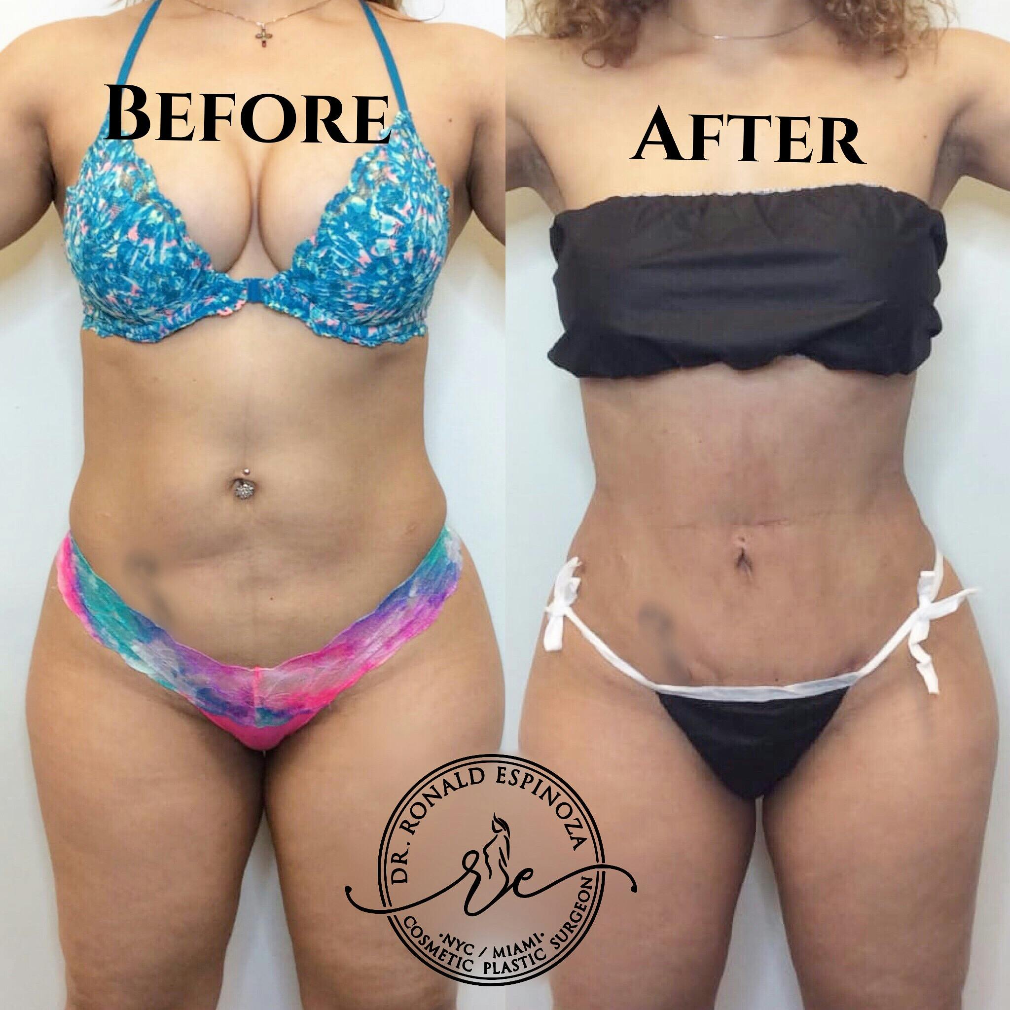 Liposuction Before & After Gallery - Patient 99345659 - Image 1
