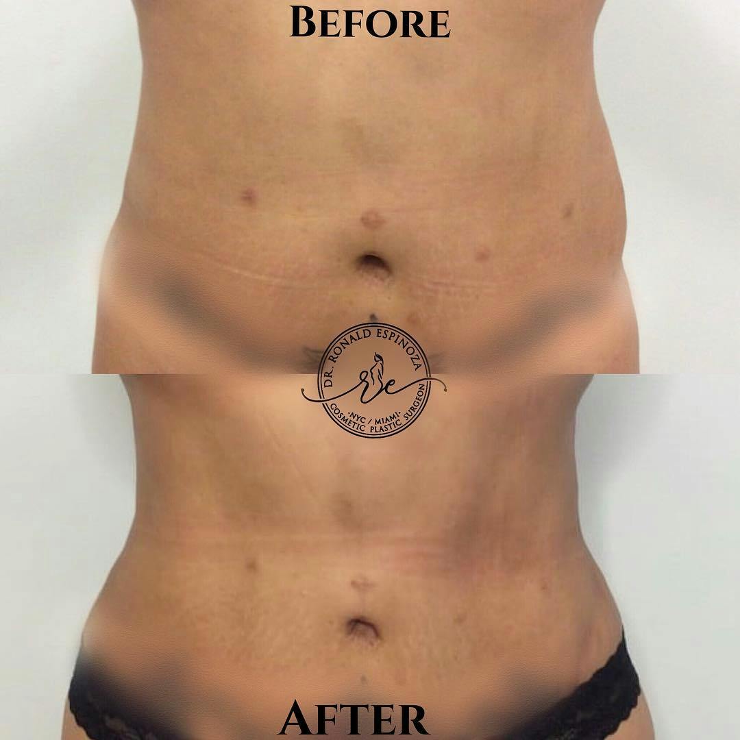 Liposuction Before & After Gallery - Patient 99345660 - Image 1