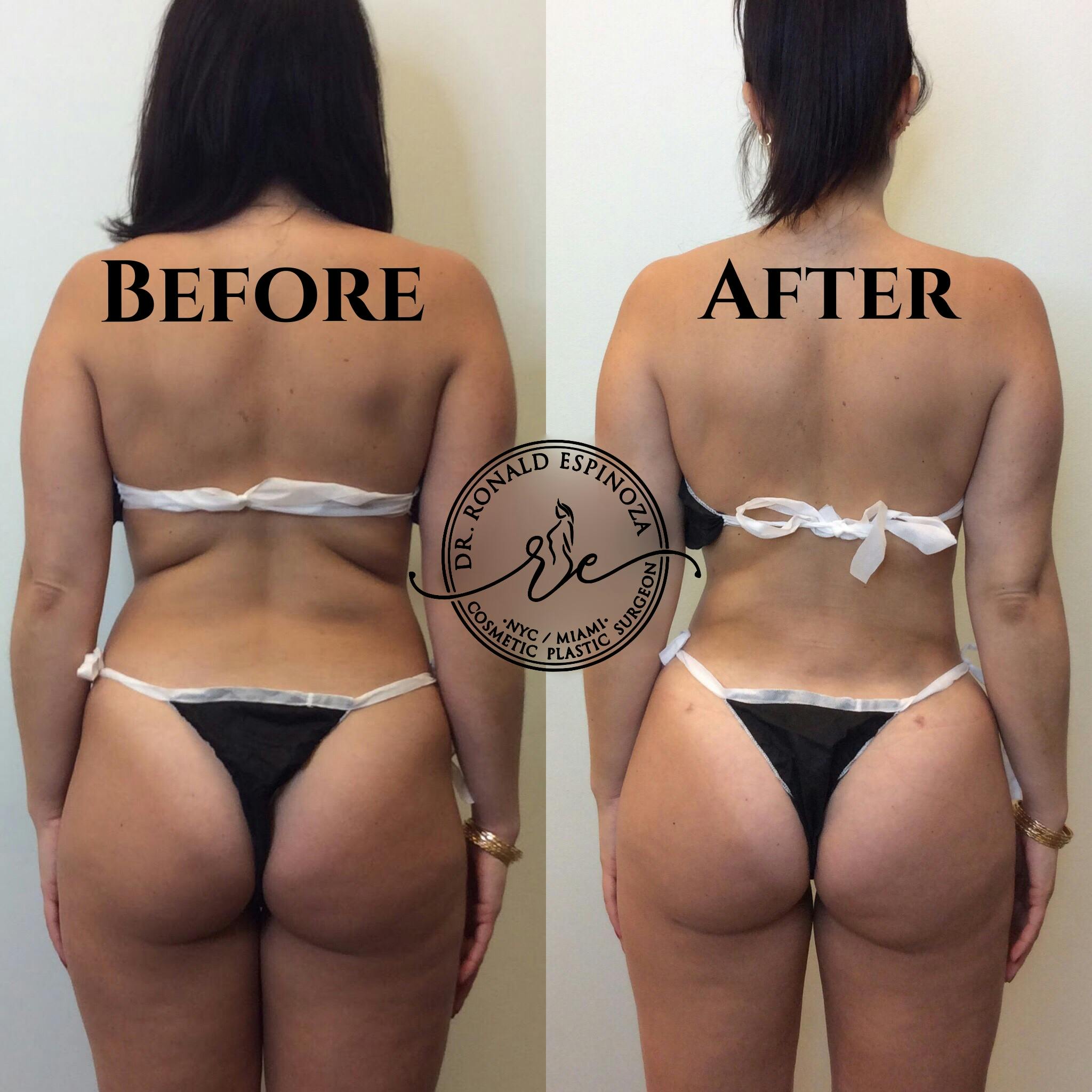 Brazilian Butt Lift Before & After Gallery - Patient 99345698 - Image 1