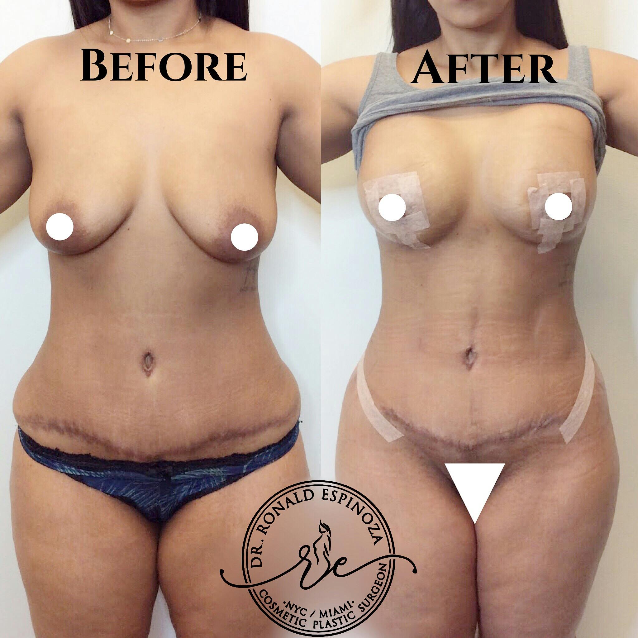 Mommy Makeover Before & After Gallery - Patient 99345746 - Image 1