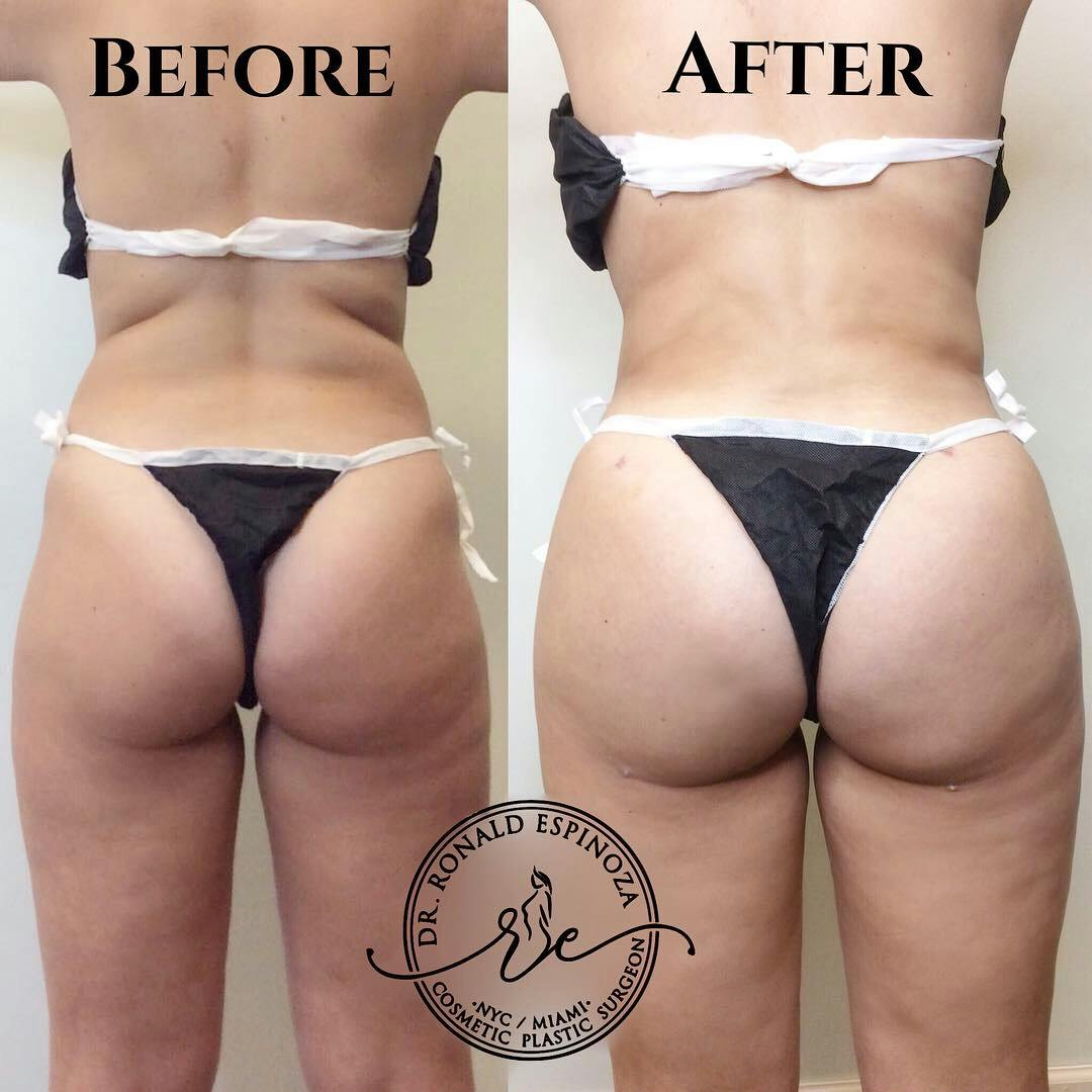 Brazilian Butt Lift Before & After Gallery - Patient 99345759 - Image 1