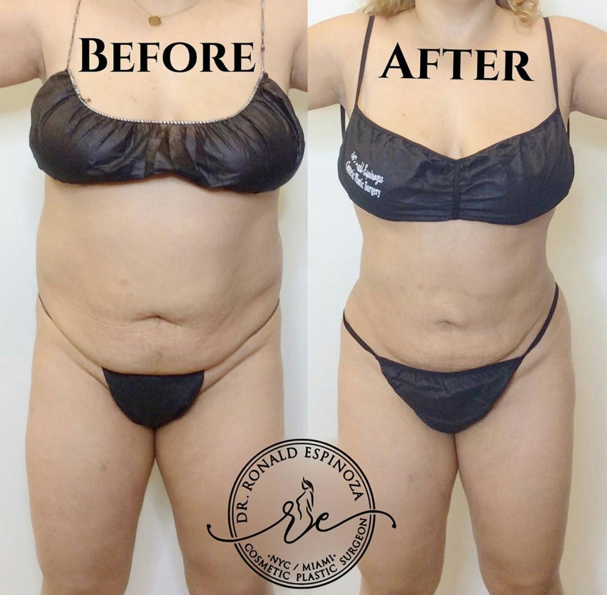 Liposuction Before & After Gallery - Patient 99345821 - Image 1
