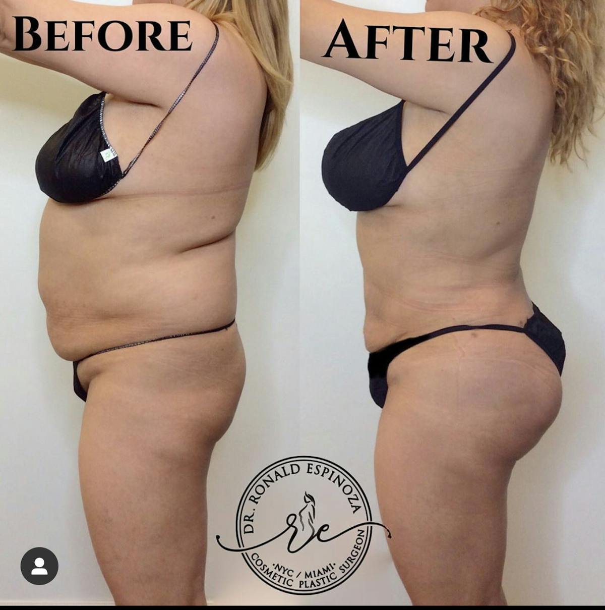 Liposuction Before & After Gallery - Patient 99345821 - Image 2