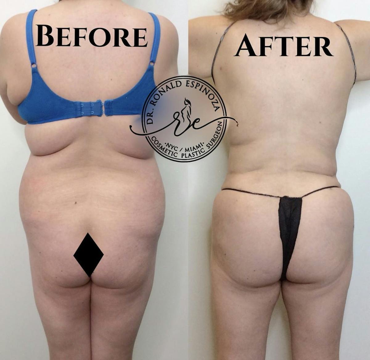 Brazilian Butt Lift Before & After Gallery - Patient 99345869 - Image 1