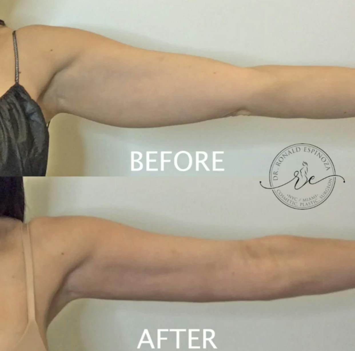 J-Plasma Renuvion Before & After Gallery - Patient 99346090 - Image 1