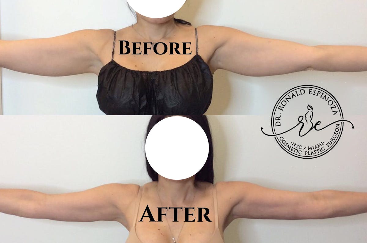 J-Plasma Renuvion Before & After Gallery - Patient 99346091 - Image 1
