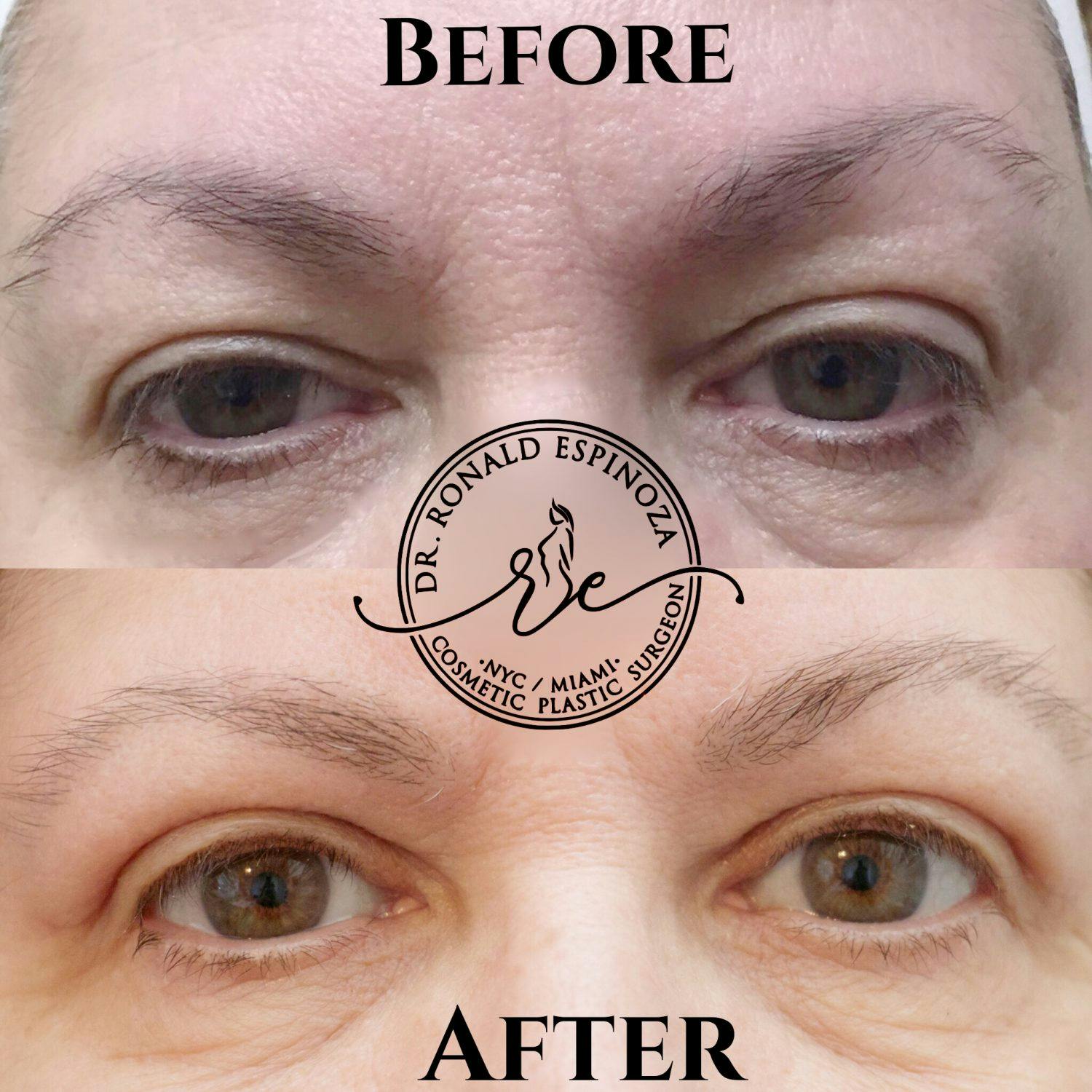 Blepharoplasty Before & After Gallery - Patient 99346132 - Image 1