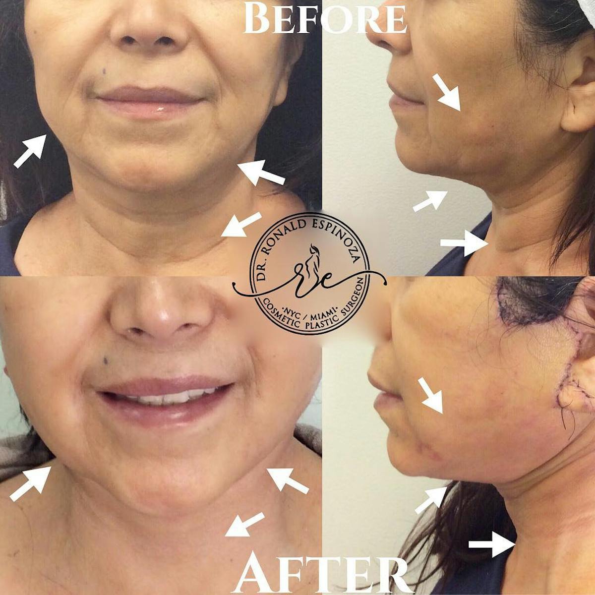 Facelift Before & After Gallery - Patient 99346176 - Image 1
