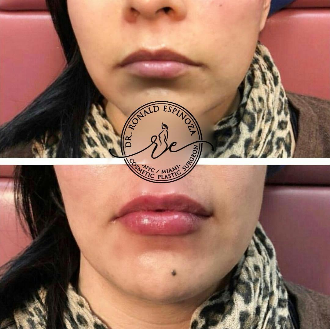 Lip Fillers Before & After Gallery - Patient 99346228 - Image 1