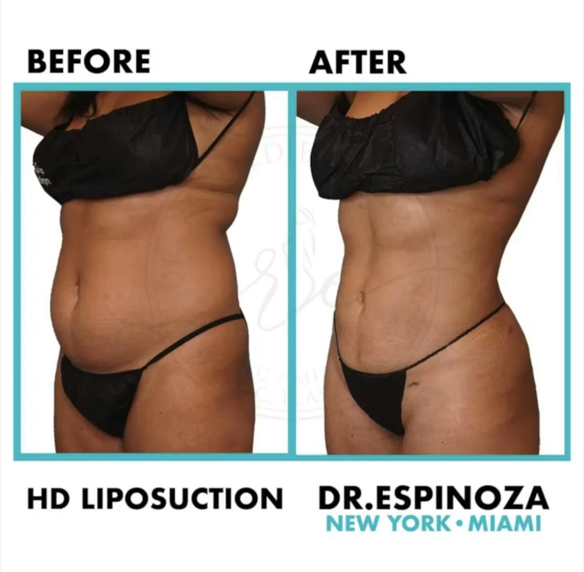 Liposuction Before & After Gallery - Patient 99346236 - Image 2