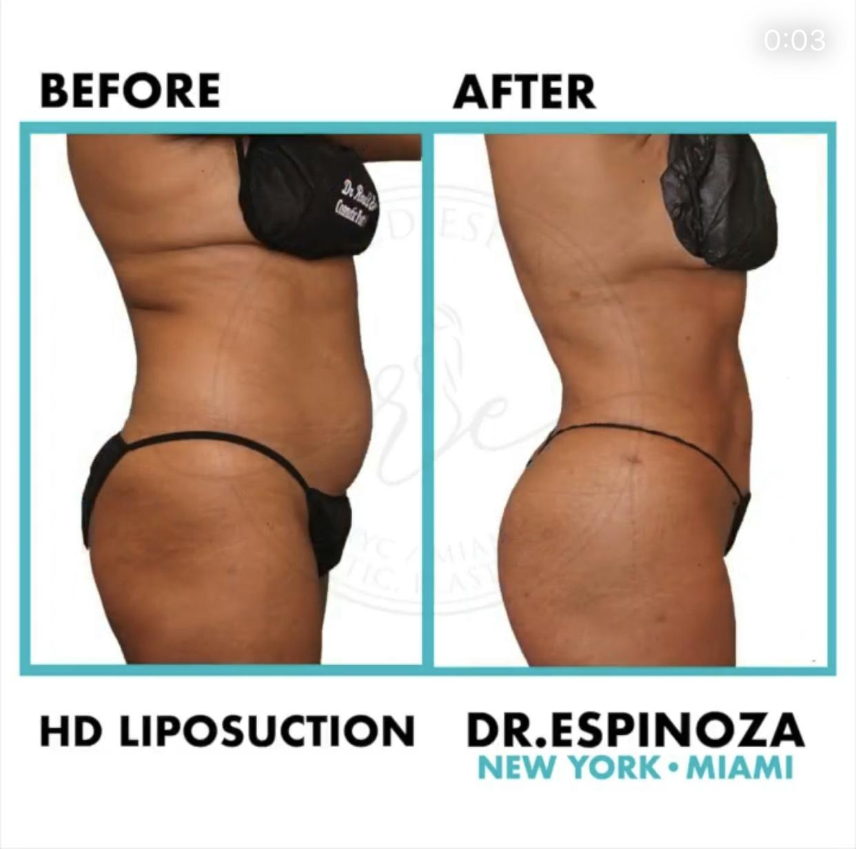 Liposuction Before & After Gallery - Patient 99346236 - Image 3