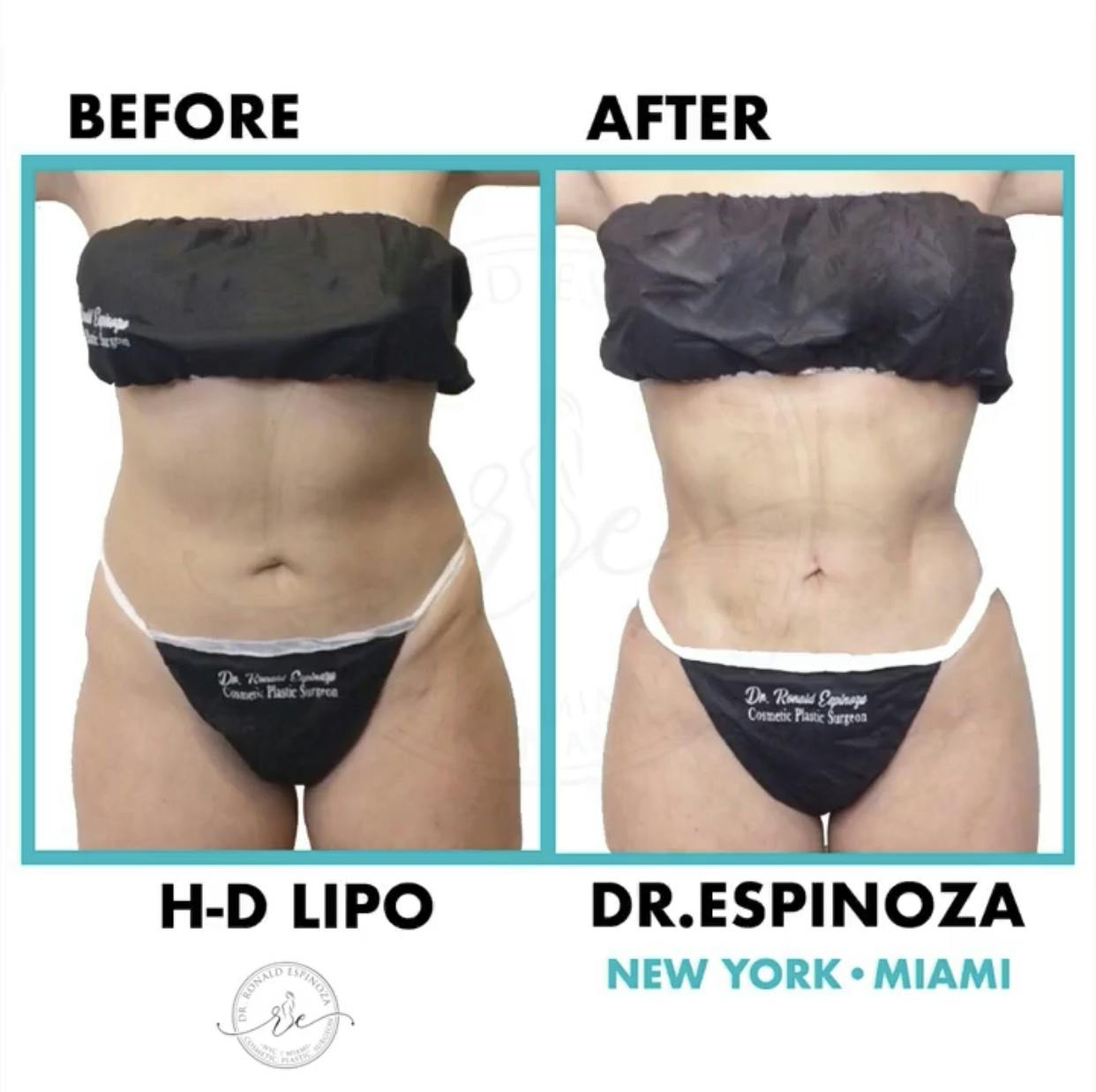 Liposuction Before & After Gallery - Patient 99346244 - Image 1