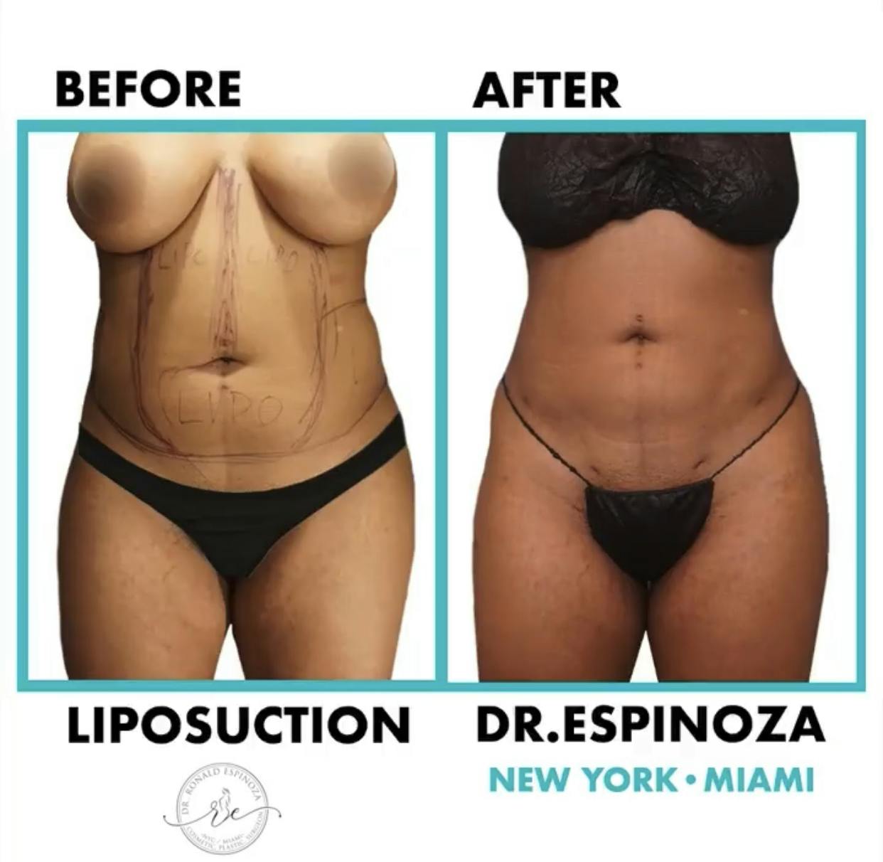 Liposuction Before & After Gallery - Patient 99346245 - Image 1