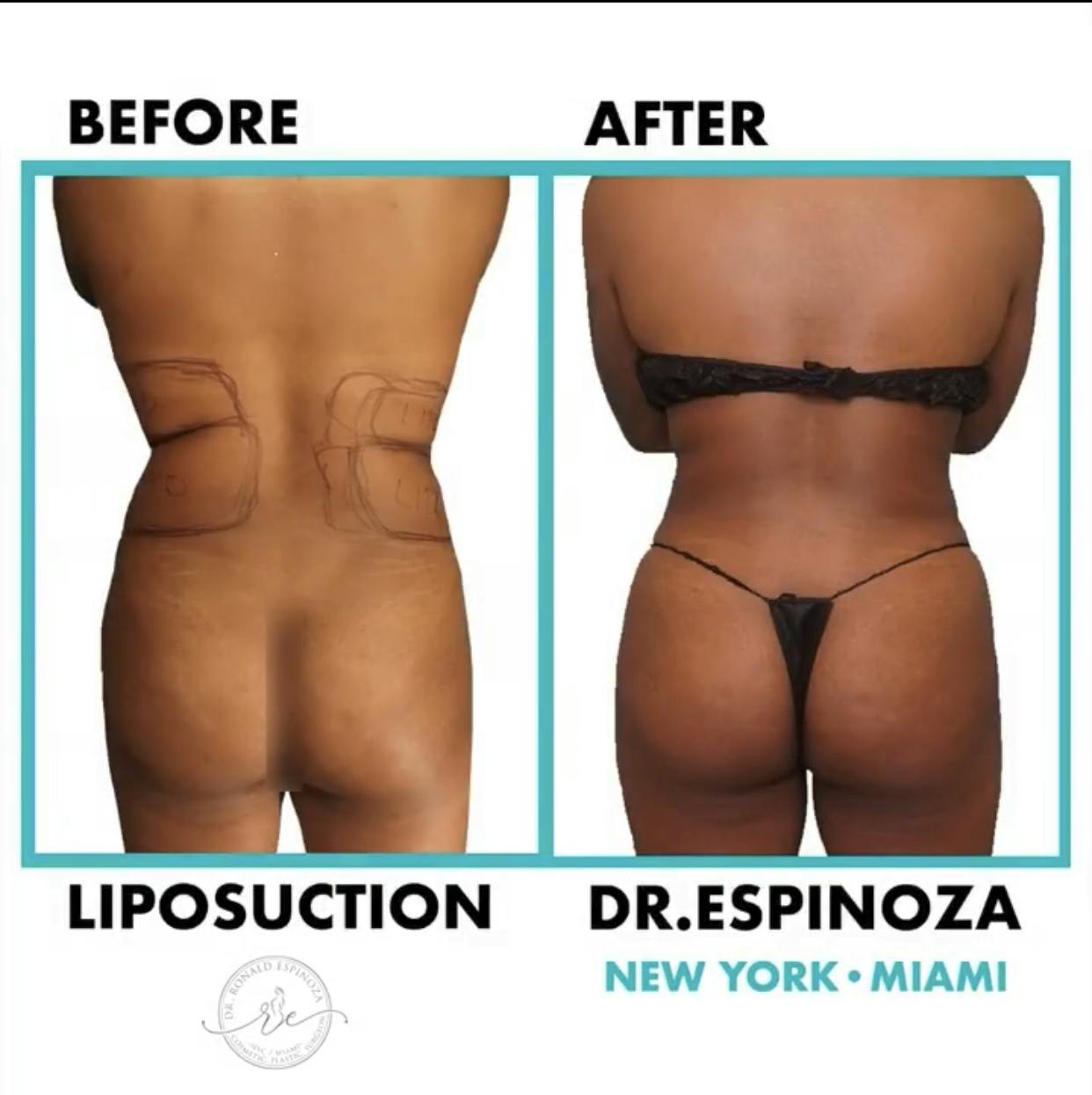 Liposuction Before & After Gallery - Patient 99346246 - Image 1