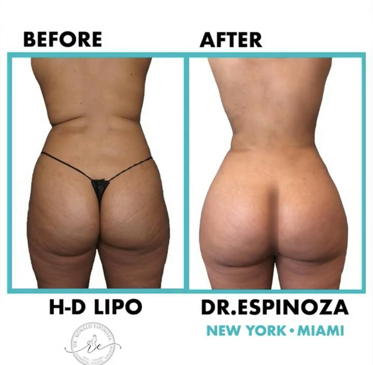 Liposuction Before & After Gallery - Patient 99346247 - Image 1