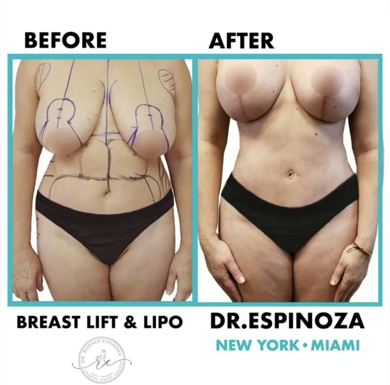Liposuction Before & After Gallery - Patient 99346250 - Image 1