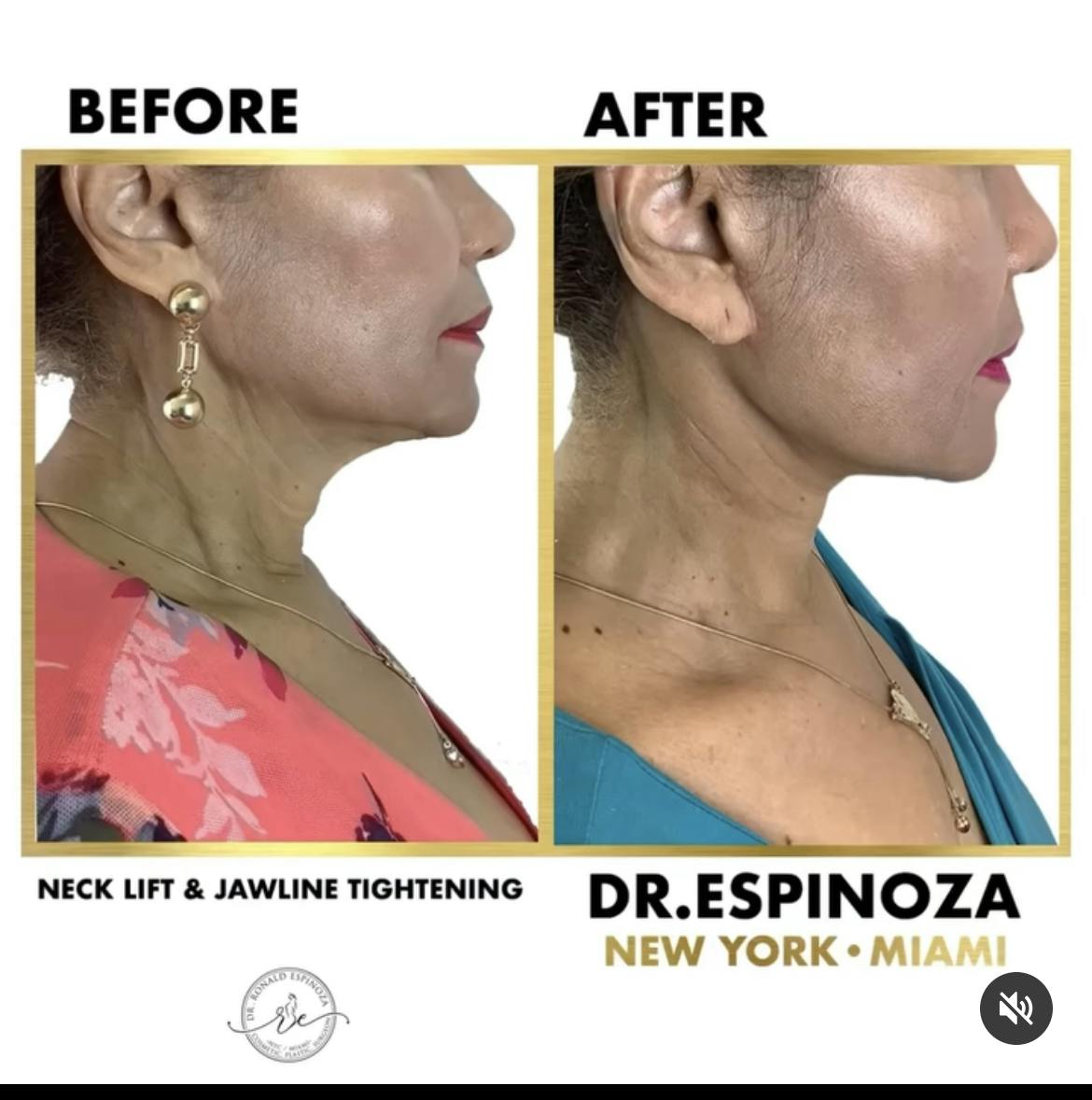 Neck Lift & Jawline Tightening Before & After Gallery - Patient 102583342 - Image 1