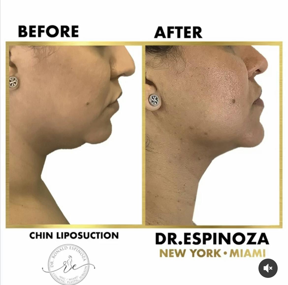 Chin Liposuction Before & After Gallery - Patient 102583348 - Image 1