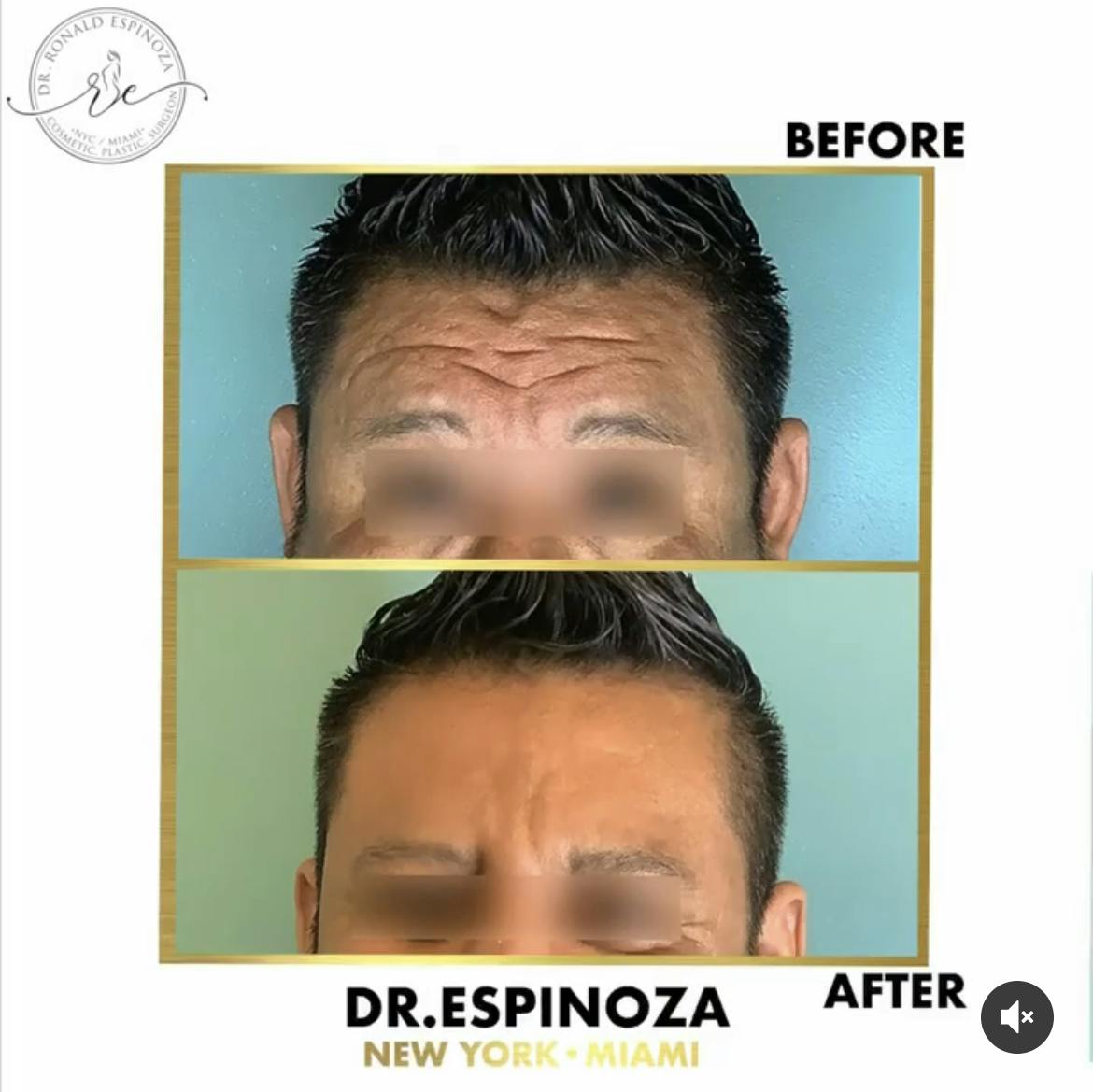 Before & After BOTOX