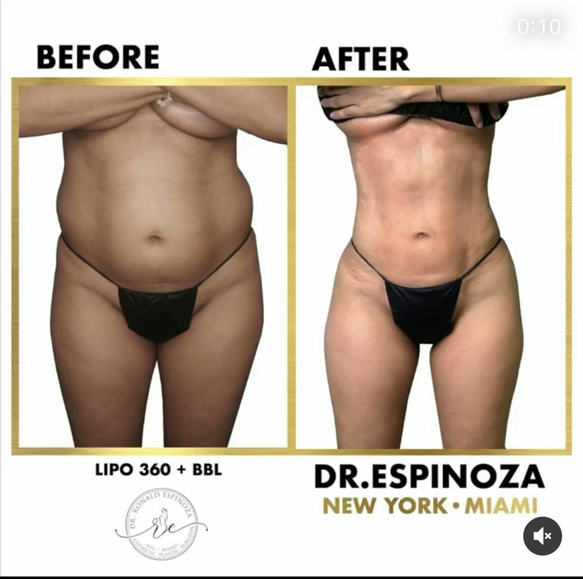 Brazilian Butt Lift Before & After Gallery - Patient 102583359 - Image 3