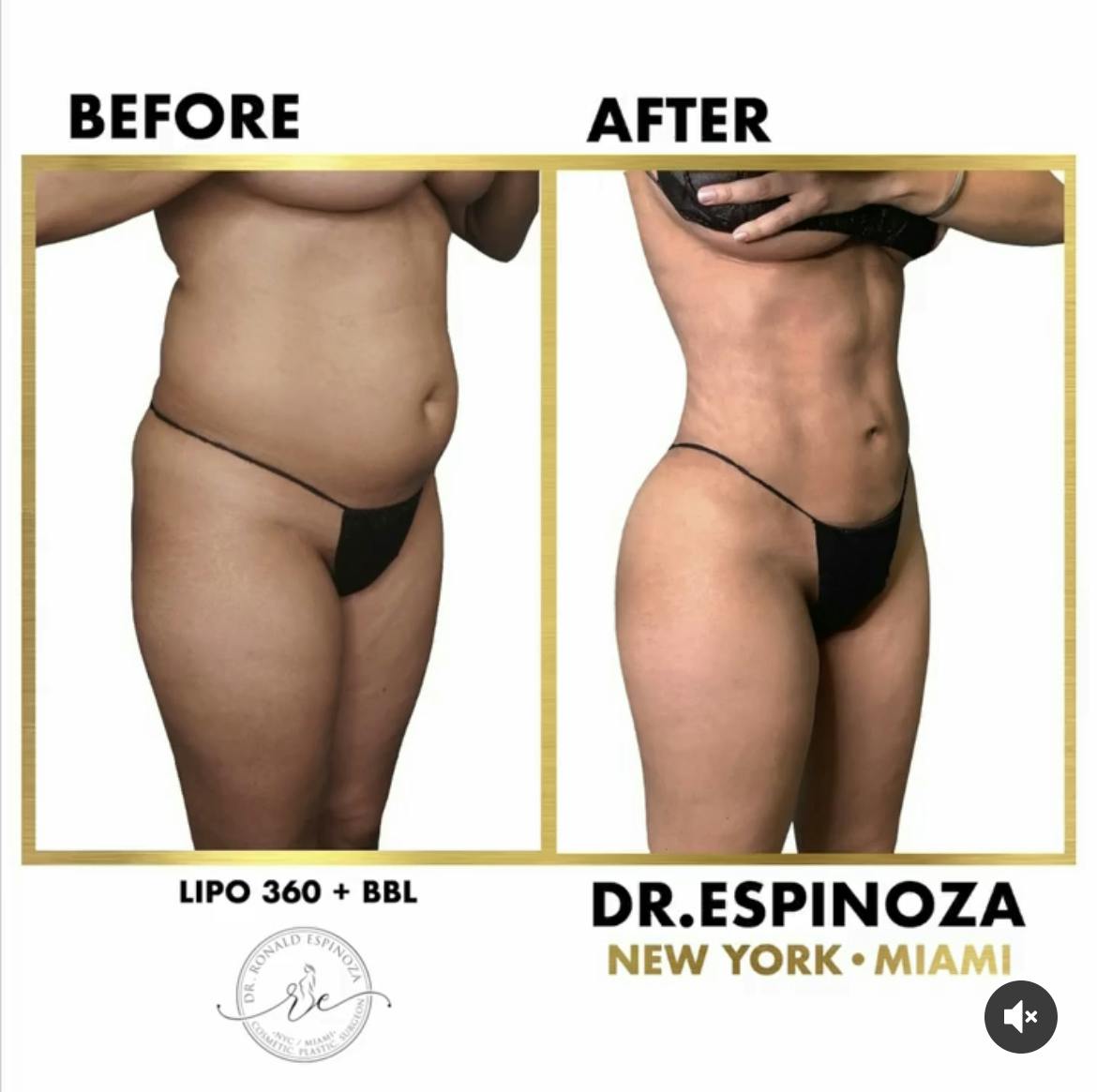Brazilian Butt Lift Before & After Gallery - Patient 102583359 - Image 2