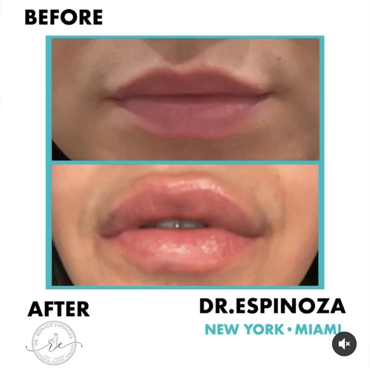 Lip Fillers Before & After Gallery - Patient 102906290 - Image 1