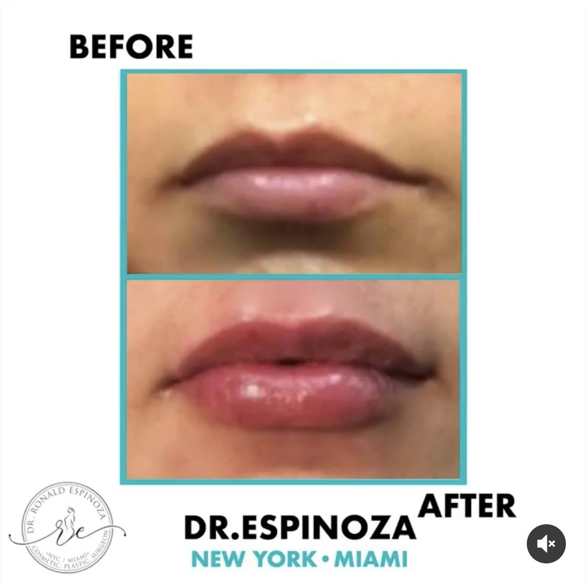 Lip Fillers Before & After Gallery - Patient 102906292 - Image 1