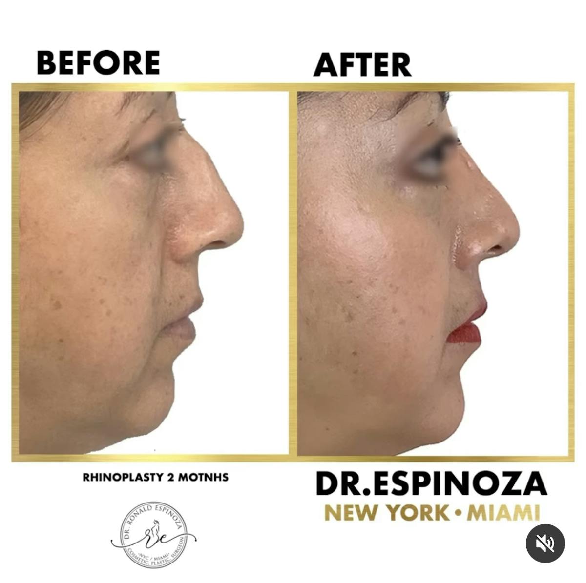 Rhinoplasty Before & After Gallery - Patient 102906348 - Image 1