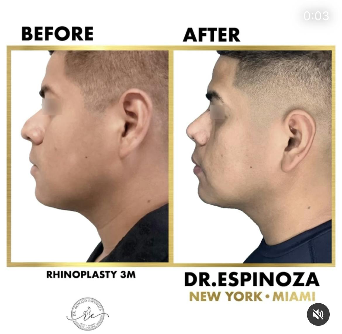 Rhinoplasty Before & After Gallery - Patient 102906347 - Image 1