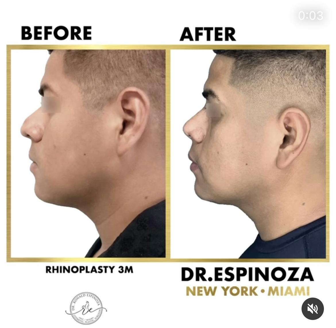 Rhinoplasty Before & After Gallery - Patient 102906347 - Image 1